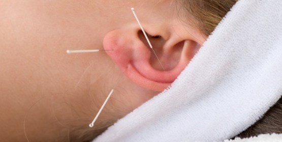 acupuntura-adelgazar