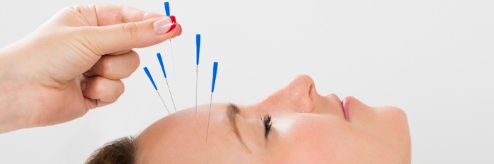 acupuntura-cefalea